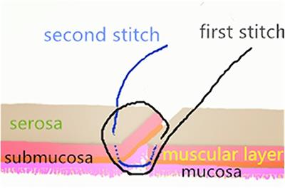 Asymmetric figure-of-eight single-layer suture technique for intestinal anastomosis: A preliminary study